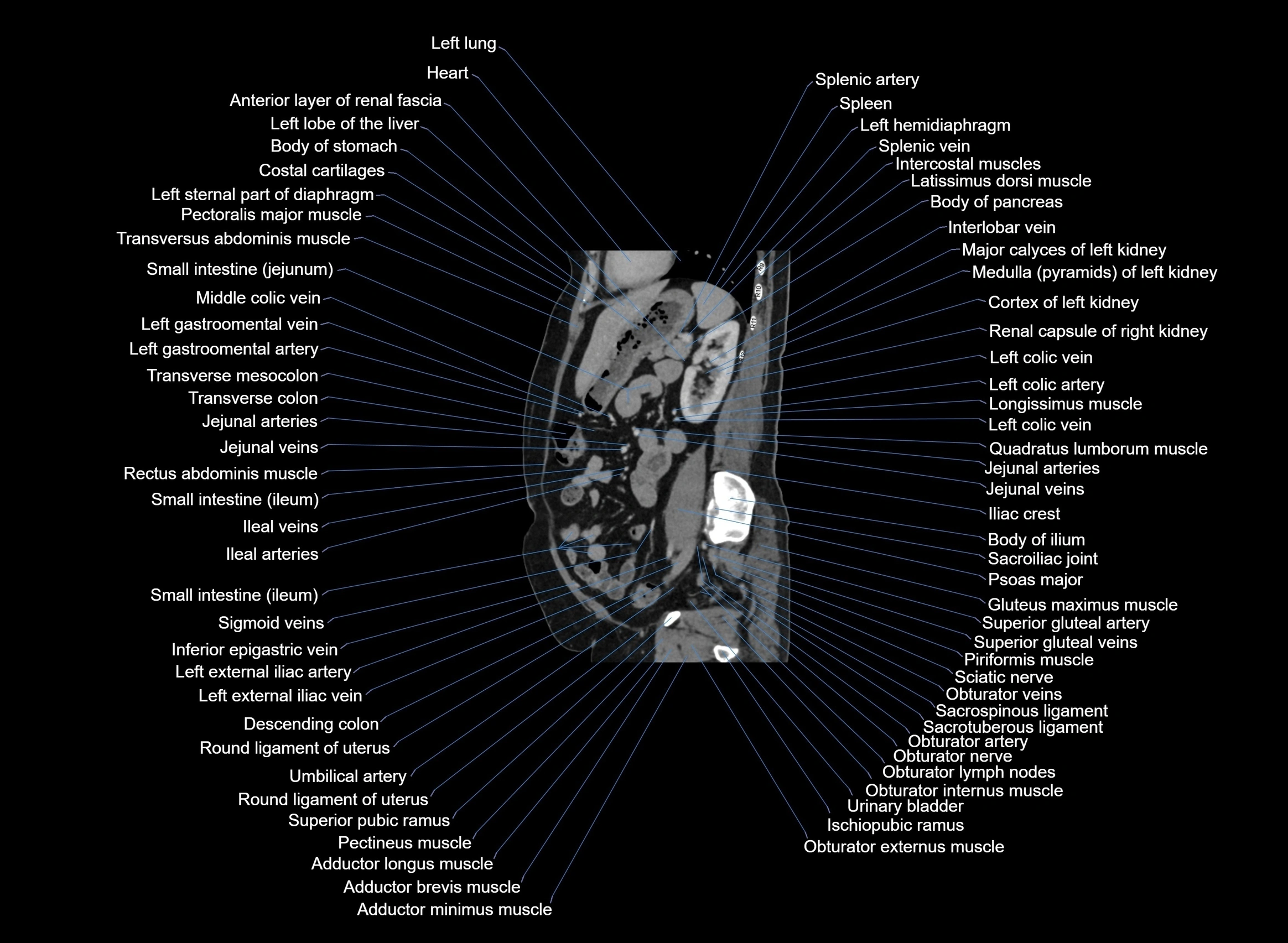 CT Abdomen sagittal cross sectional anatomy labelled radiology image -00041.webp